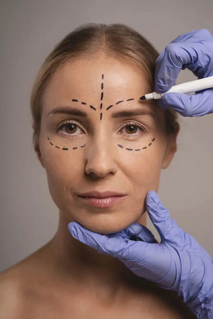 blefaroplastia: cirurgia de pálpebras